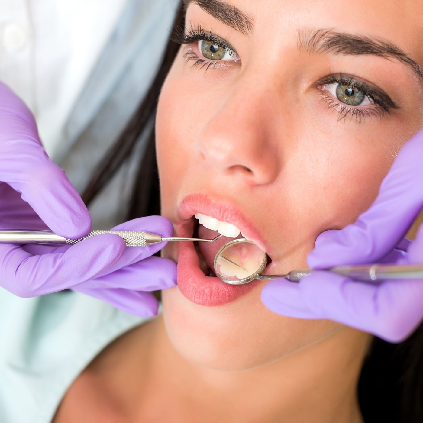 Microabrasão Dental: Guia Completo para Remoção de Manchas Superficiais e Sorriso Radiante 14 0746c96c4b7d477a9c7ee18adeded416