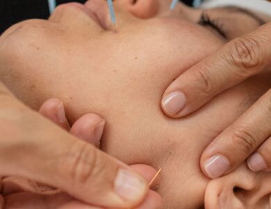 Acupuntura: 10 Dúvidas Mais Comuns Respondidas Para Você Entender e Aproveitar os Benefícios